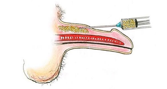 Injeções de ácido hialurônico no barril de um membro para aumentá -lo